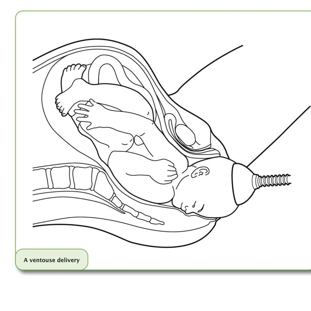 How to avoid an assisted birth with either forceps or ventouse (suction) swipe right…, slide 3
