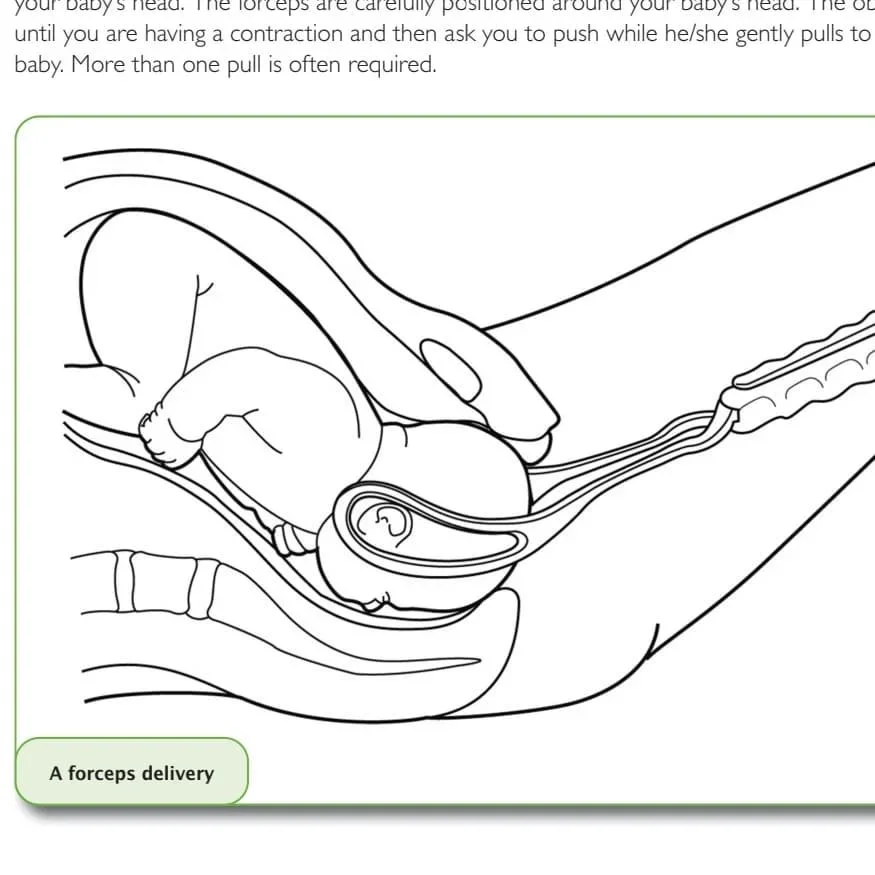 How to avoid an assisted birth with either forceps or ventouse (suction) swipe right…, slide 2