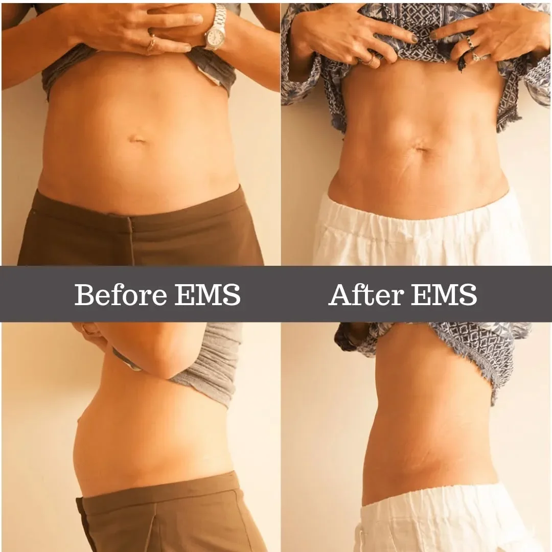 Diastasis Recti is a common tummy muscle separation, or tummy gap, which involves the…, slide 2