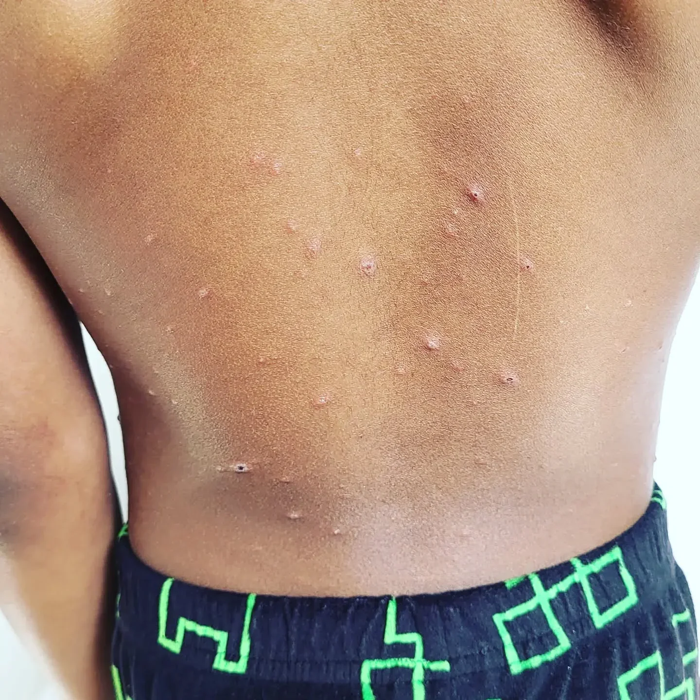 My two youngest have finally succumbed to chicken pox, slide 4